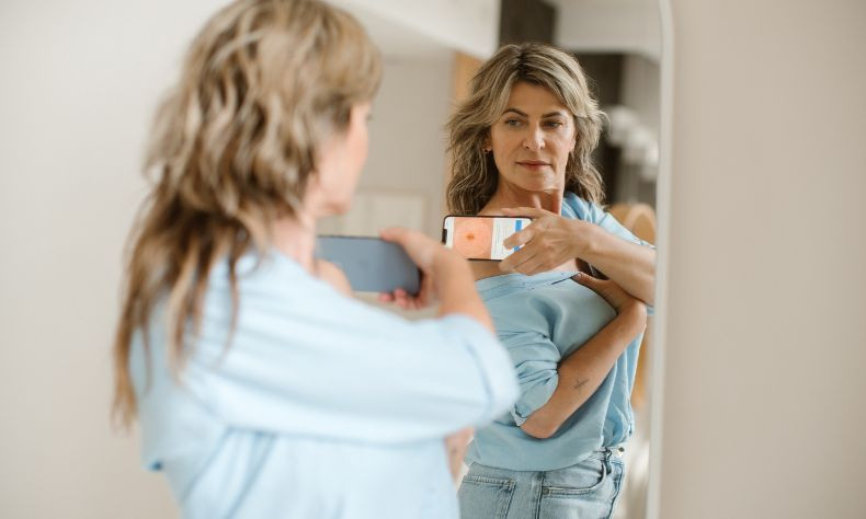 Check your moles with Skin Vision!